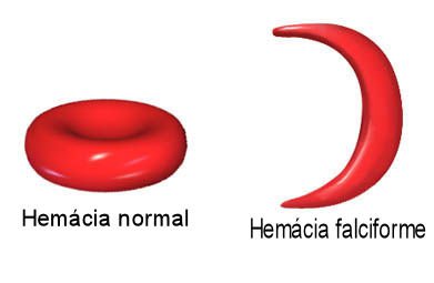 Fig4: Anemia falciforme
