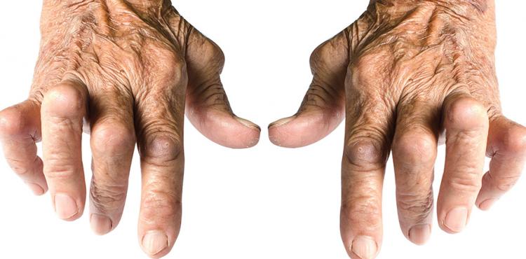 Fig.34: Artrite reumatóide
